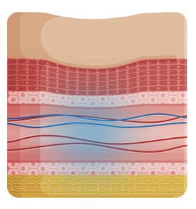 PDLLA持續剌激膠原