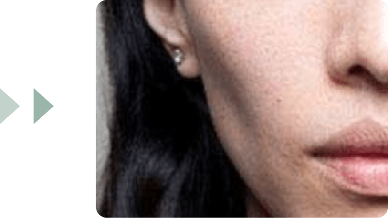 全臉或局部凹陷